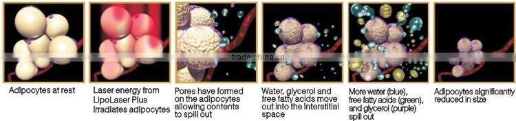 Quick slim! supersonic ultrasound machine LP-01/CE i lipo laser slim laser liposuction