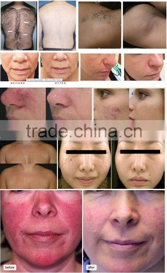 3 handle 1800w Multifunctional hair removal ipl+rf elight