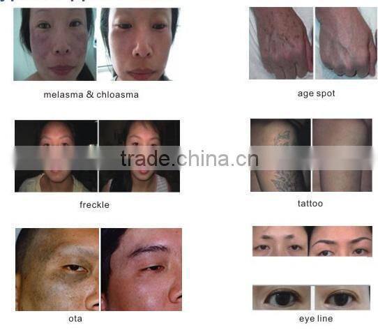 Clinical Laser RBS Vascular Veins Spider Vein Removal Device for Skin Disorder Treatment