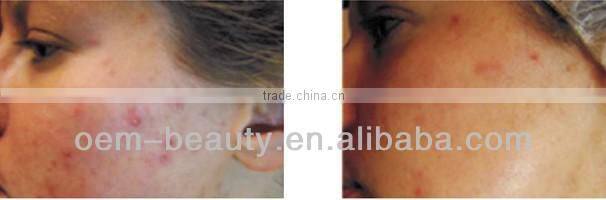 Portable elight ipl rf wrinkle removal ipl filter for hair removal machine C001