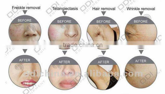 CE OD A900 smooth skin machine for wholesale beauty supply equipment skin pigmentation treatment