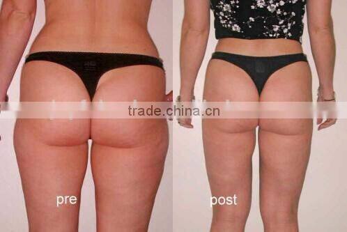 criolipolisis fat freezing machine ultrasonic liposuction JF800