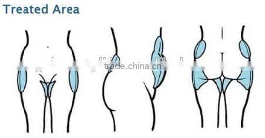 portable cryolipolysis equipment