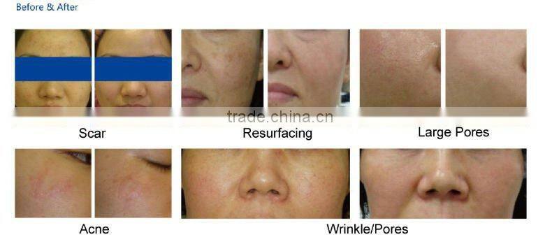 Fractional CO2 Vaginal Tightening Laser