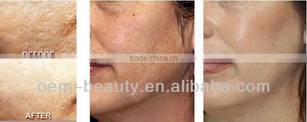Most effective elight ipl rf laser hair removal and skin rejuvenation equipment
