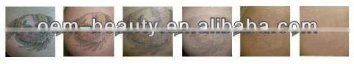 the excellent beauty machine Nd.Yag Laser tattoo removal for sale