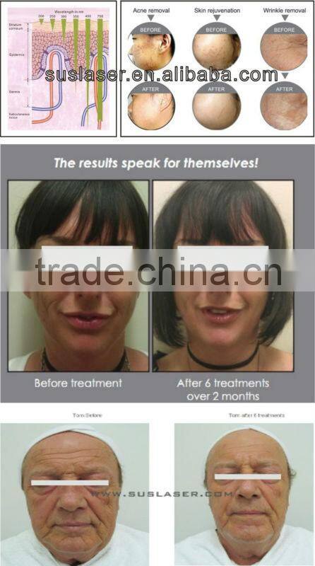 PDT/LED biolight skin care device BL001, CE/ISO professional pdt led light therapy equipment for s