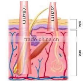 Tattoo Removal Laser Nd Yag Laser