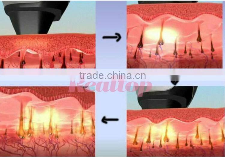 Strong Power!! Factory direct sale epilator laser hair removal machine 808nm diode equipment