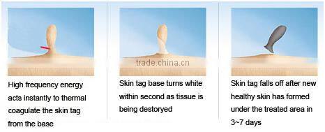 Spider vein cure beauty device laser equipment for spider veins