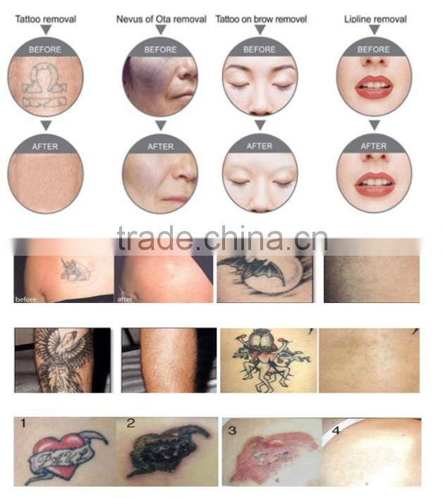 Medical CE approved yag laser machine / Nd yag laser / Q switch nd yag laser