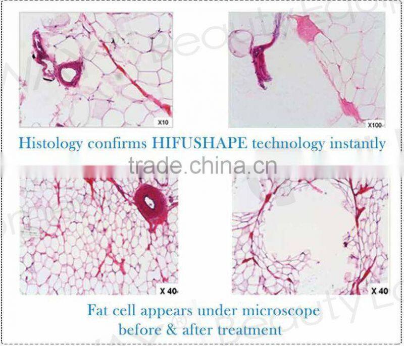 professional slimming machine hifu fat reduction system