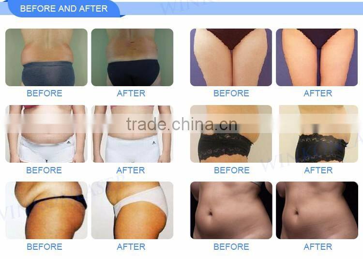 2017 Newest painless body shaping 2 years warranty ultralift hifu liposonix machine for weight loss