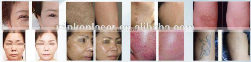 lazer hair removal machine / hair removal for women