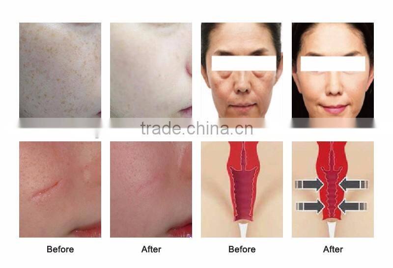 Co2 fractional laser machine popular co2 laser for vaginal tightening