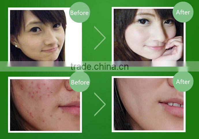 Acne treatment products skin care natural tea tree oil effective anti-acne face mask