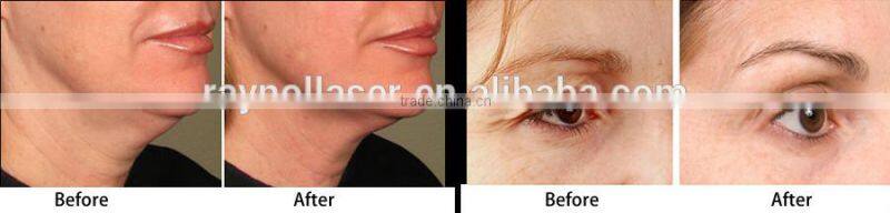 Fractional MicroNeedle RF Facial Rejuvenation Machine