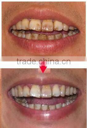 GTO teeth whitening kit