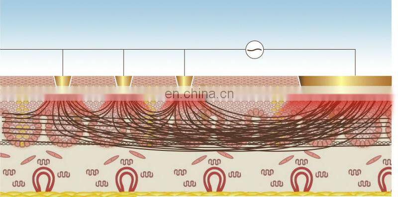 Fractional RF machine- GSD Dermatrix