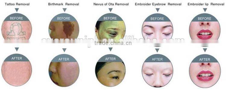 Hotest Ruby Q-switch laser tattoo & eyebrow removal machine EVERSUN XP407