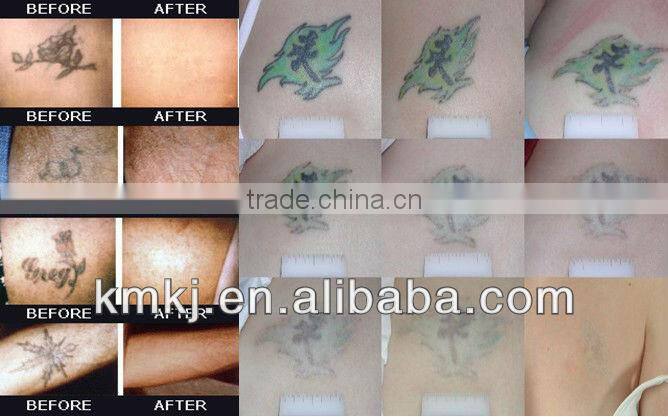 2015 tatoo removal with Q-swich nd yag laser