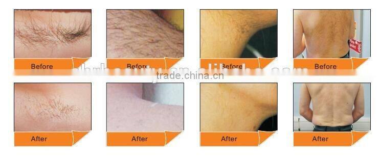 Hot sale 808nm Diode Laser Depilation Upper Lip Hair Removal Machine
