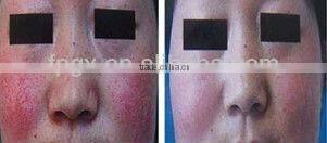 High energy Nd yag Laser /Cavitation / RF /E-light IPL Hair Removal