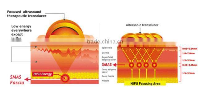 Profession hifu facial machine
