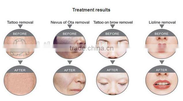 Stock machine in Moscow!Professional q switch nd yag laser for tatoo removal factory price with Medical CE nd yag laser price