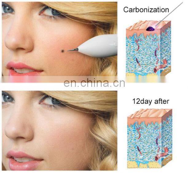 Laser Mole Removal Tool Dark Spot Remover Freckle Tattoo Wart Pen Machine Skin