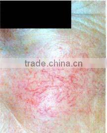 Portable High Frequency Blood Vessels Removal Device