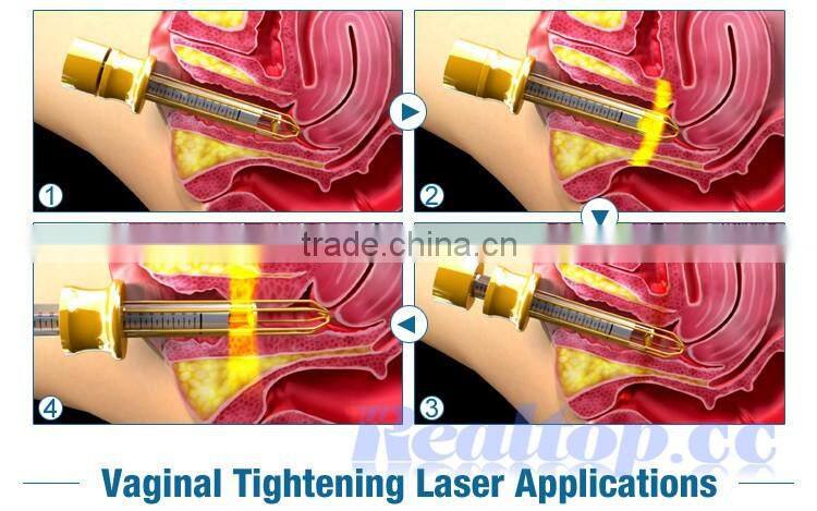 Surgical Scar removal fractional co2 laser equipment for vaginal tightening facial acne pit removal