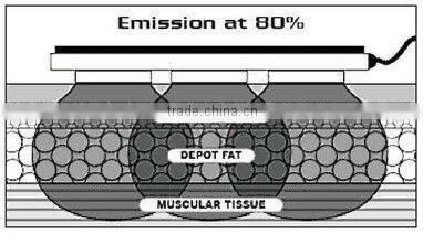 HIFU vrf rf cellulite loss treatment