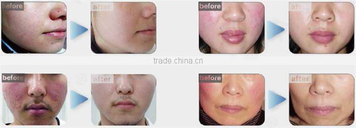 Clinical medical laser varicose veins laser treatment NBW-V600