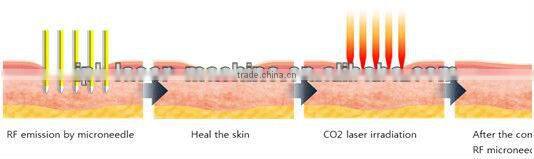 High performance !!! best fractional rf needle for sale