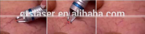 QTS 2016 Blood Vessels spider veins Removal ,with 980nm wavelength laser