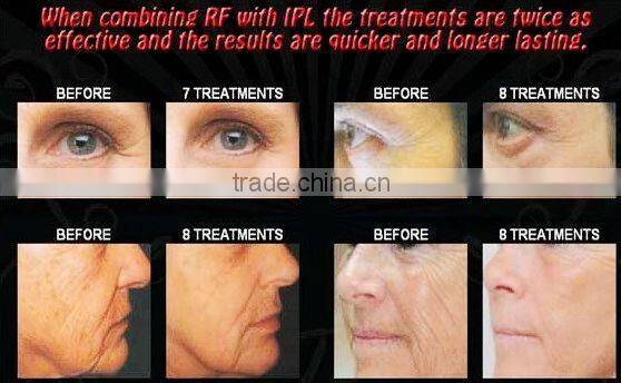 Professional Portable E-light IPL RF Hair Removal C001 with CE