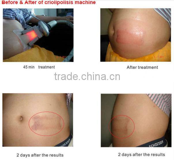 M-C201 2016 Updated slimming machine/portable fat freezing machine/fat freezing machine for home use