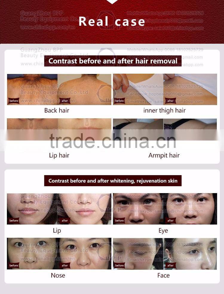 Home use !! 808 diode laser hair removal laser home use