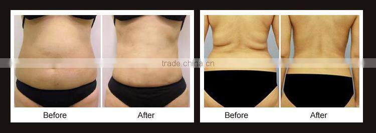 liposuction alternative tickle for weight lost body shaping machine