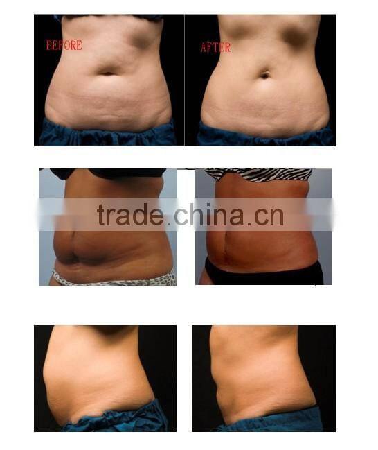 OL-1001B cavitation facial care beauty machine for skin tightening