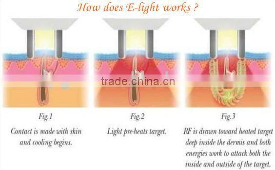 Customized most popular ipl rf