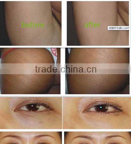 CDT CO2 skin rejuvenation carboxy therapy beauty machine with CE certification for sale