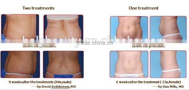 High quality cryotherapy price cryolipolysis freezing machine