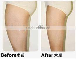 6 in 1 ultrasound + RF multifunctional cavitation weight lose machine