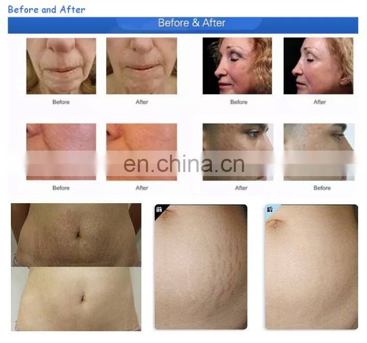 microneedle fractional rf eye bag removal radio frequency skin tightening machine Micro Needle Fractional RF beauty Machine