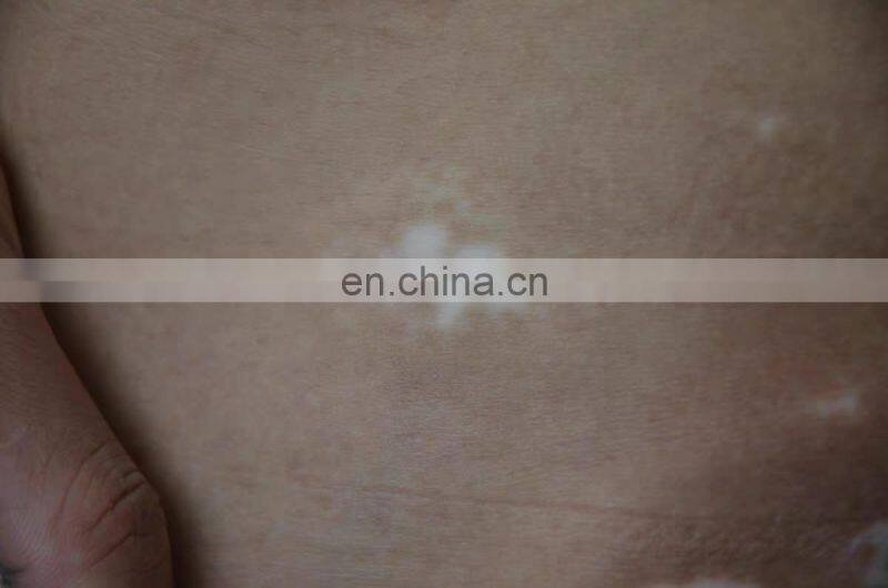 308 nm excimer laser machine fototerapia dermatologia any new puva treatment psoriasis vitiligo light system india price