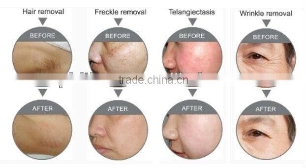 Hair removal machine price hair removal men hair removal instrument