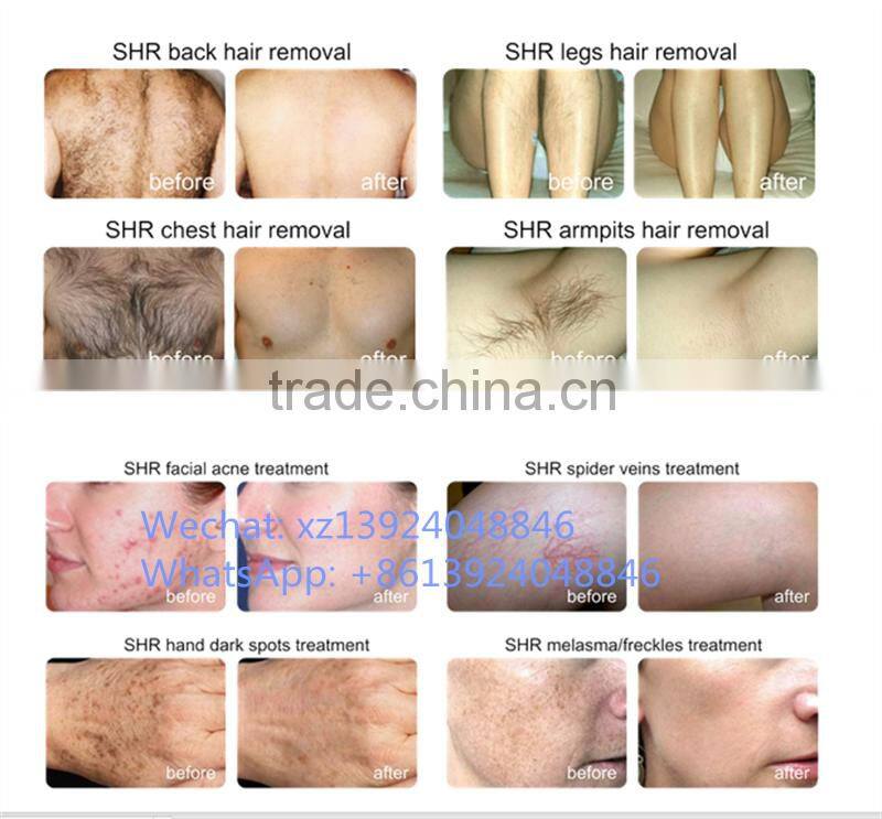 Skin care products acne scar removal & ipl shr opt hair removal beauty equipment