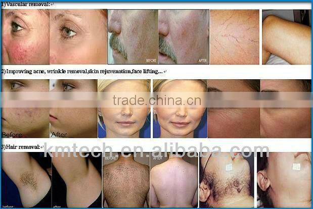 Newest design e-light ipl rf+nd yag laser multifunction machine